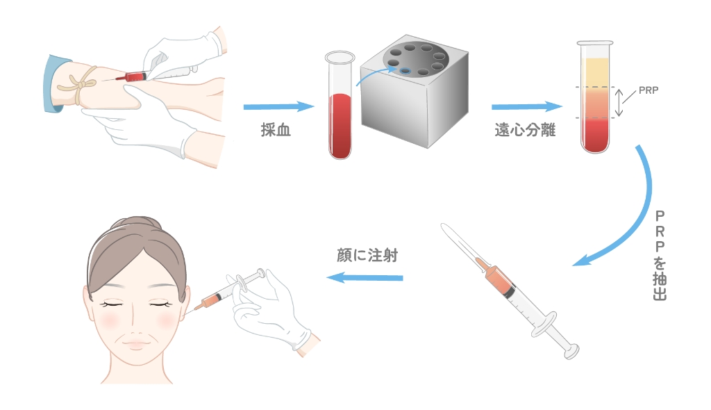 PRP（皮膚再生療法）治療の手順を示すイラスト。まず血液を採取し、遠心分離機で分離してPRPを抽出。最後に顔に注射する様子が描かれている。